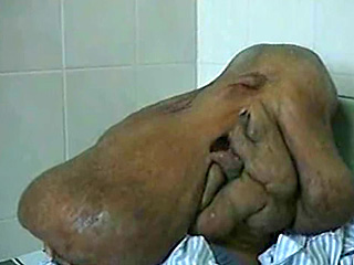 "Человеку-слону" удалят опухоль весом 15 кг