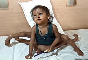 Девочку, родившуюся с четырьмя руками и ногами, спасет операция (ФОТО)
