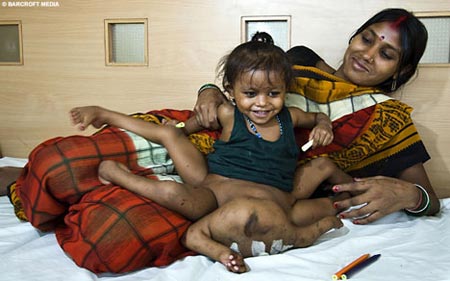 Девочку, родившуюся с четырьмя руками и ногами, спасет операция (ФОТО)