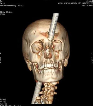 Подросток выжил после того, как металлическая труба пробила его череп (ФОТО)