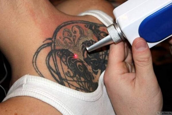 Как безопасно и эффективно свести татуировку