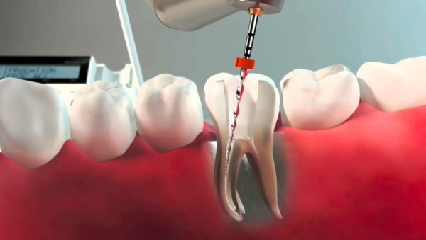 Все нюансы удаления нерва зуба простыми словами