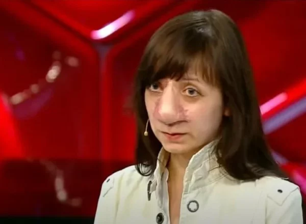 Как изменилась Яна Муратова, которая перенесла 19 операций на носу