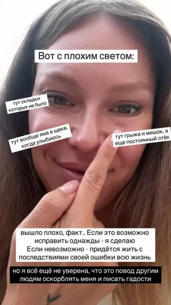 "Я уродина", - Рита Дакота показала результаты пластики