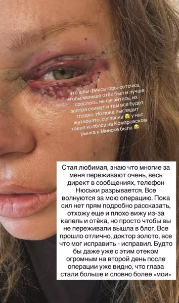 Певица Рита Дакота показала жуткие кадры лица после пластики за 1,7 млн рублей