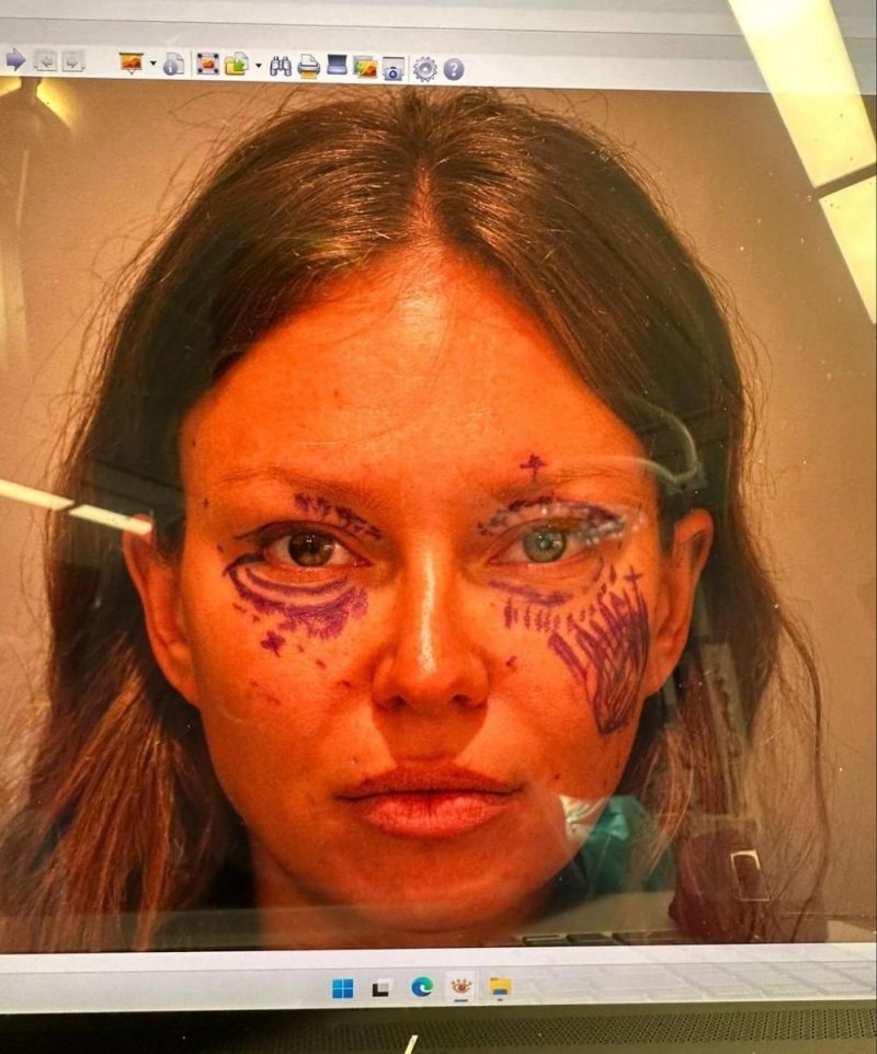 «Тормозит глаз и дыра в щеке»: Рита Дакота расплачивается за бьюти-ошибку и хочет вернуть время назад