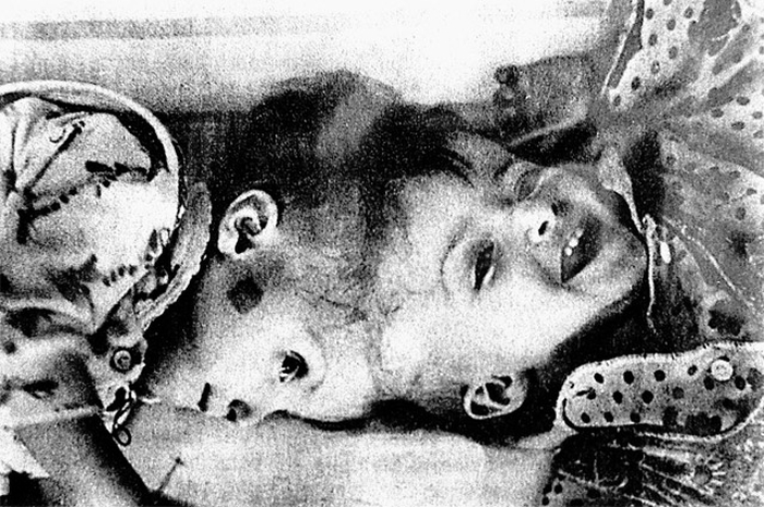 Разделённые судьбы: шокирующая история близнецов, сросшихся головами