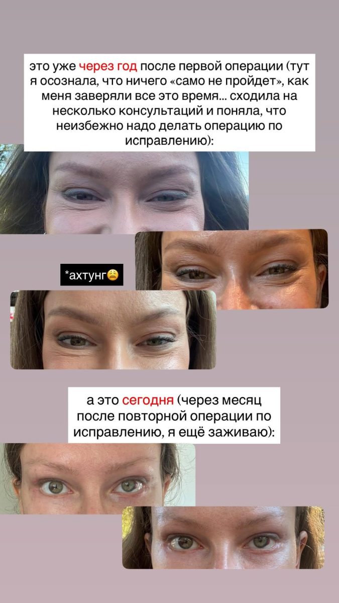 Рита Дакота после неудачной блефаропластики: липофилинг, отёки и повторная операция