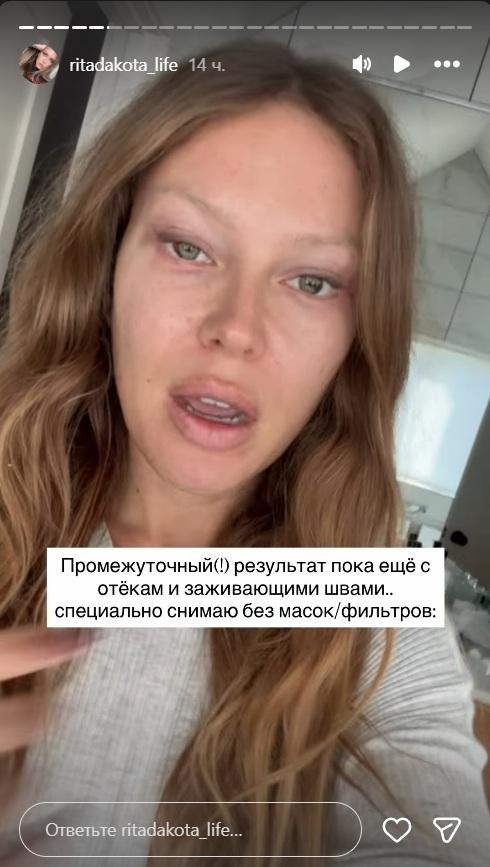 Рита Дакота после неудачной блефаропластики: липофилинг, отёки и повторная операция