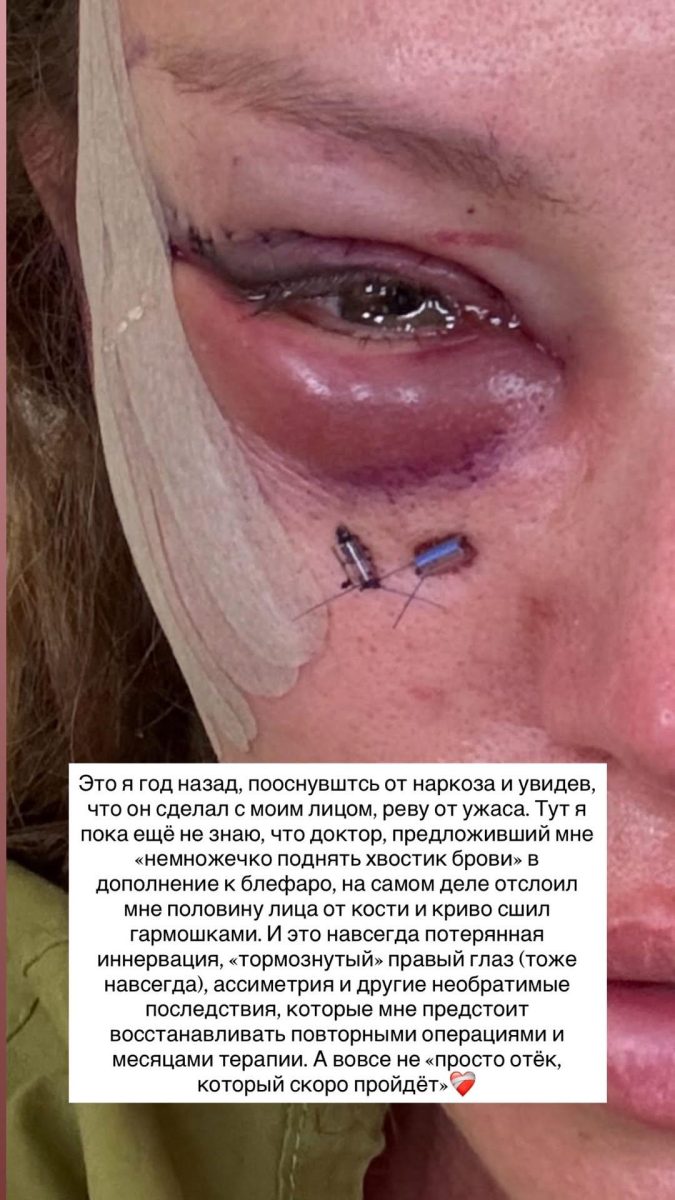 Рита Дакота после неудачной блефаропластики: липофилинг, отёки и повторная операция