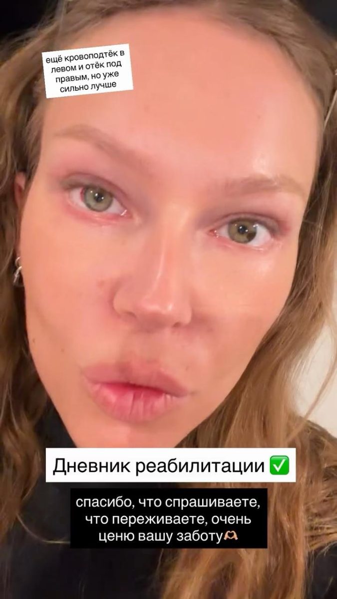 «Тормозит глаз и дыра в щеке»: Рита Дакота расплачивается за бьюти-ошибку и хочет вернуть время назад