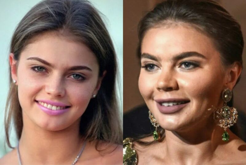 Алина Кабаева: до и после предполагаемых бьюти-процедур.