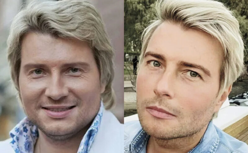 Николай Басков: до и после коррекции лица.