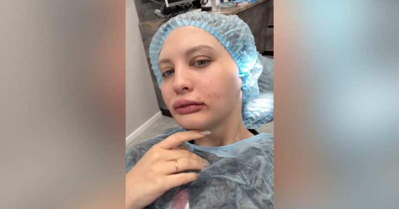 Мелисса Волынкина перенесла операцию на челюсти.