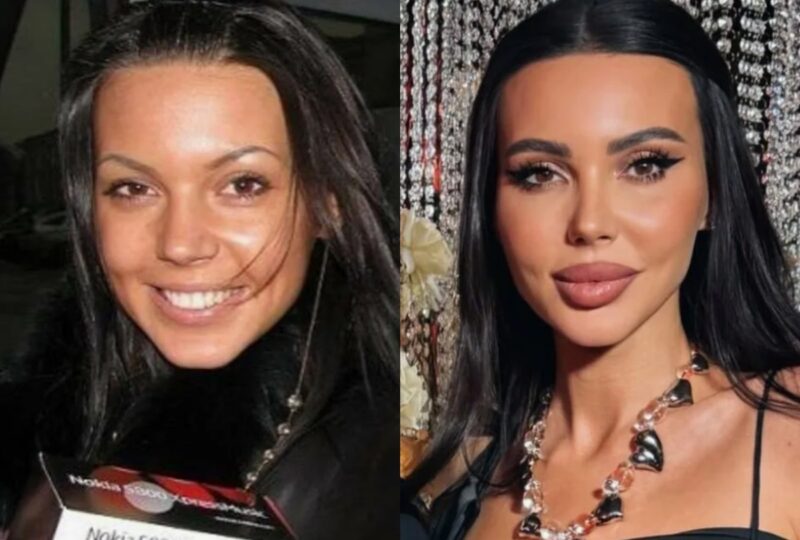 Оксана Самойлова: открытые признания о пластике