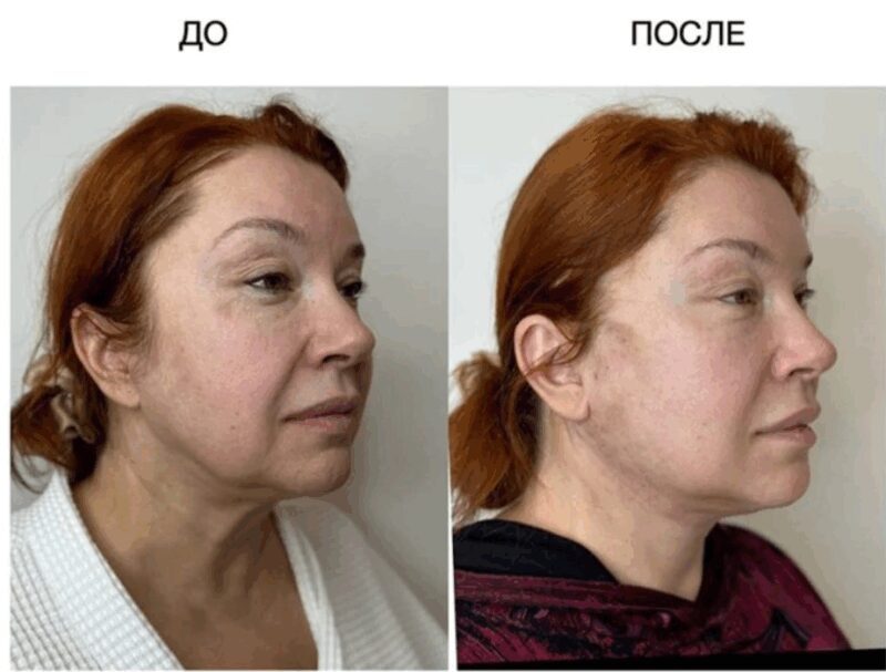 Неудачная косметологическая процедура привела Веру Сотникову к судебным разбирательствам с клиникой.