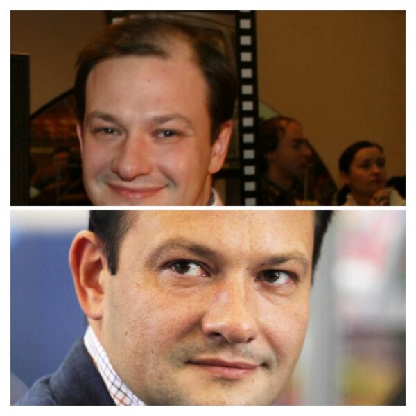 "Всю носоглотку вырезали": как операция изменила лицо и жизнь ведущего "Вестей" Сергея Брилева