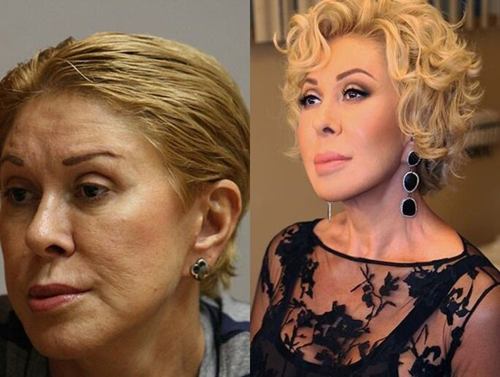 "Лисьи глазки" за 250 тысяч: Боня "как Джексон", а Бабкина «опошлила» лицо в 76 лет