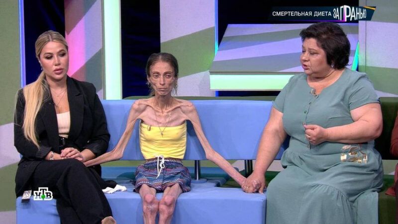 «Пухлые щёчки» ценой в жизнь: как роковая фраза мужа довела Яну Боброву до 20 кг и что спасло её