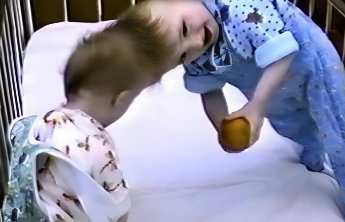 Сросшиеся головами: как сестры Тамулявичюте выжили после уникальной операции и что с ними стало спустя 35 лет