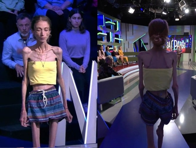 «Пухлые щёчки» ценой в жизнь: как роковая фраза мужа довела Яну Боброву до 20 кг и что спасло её