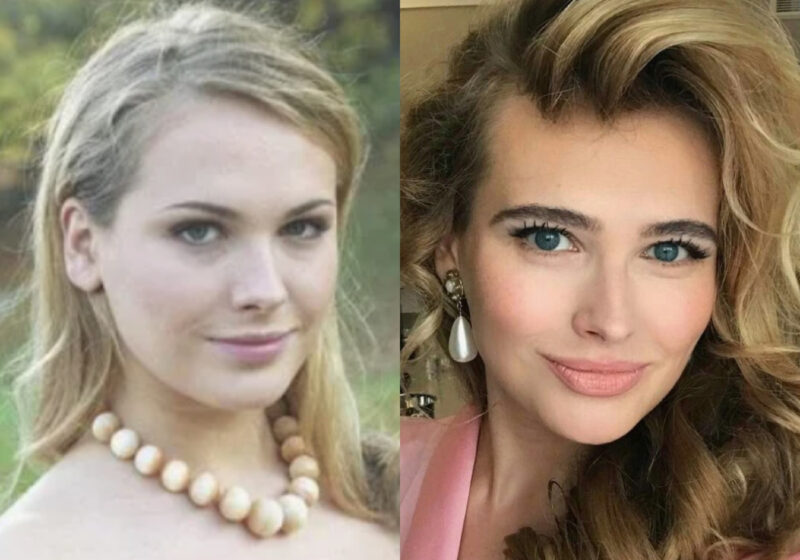 Анна Горшкова: до и после вмешательств