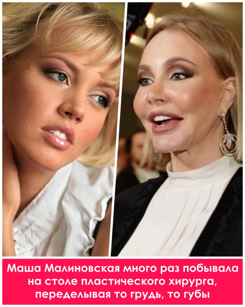 Цена совершенства: как пластика изменила жизни российских звезд