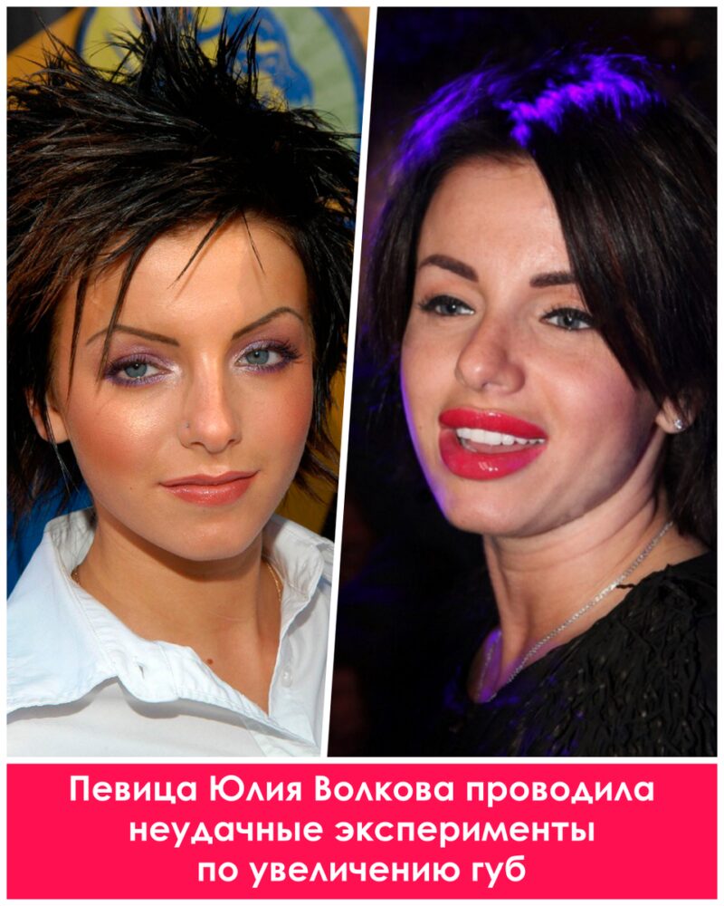 Цена совершенства: как пластика изменила жизни российских звезд