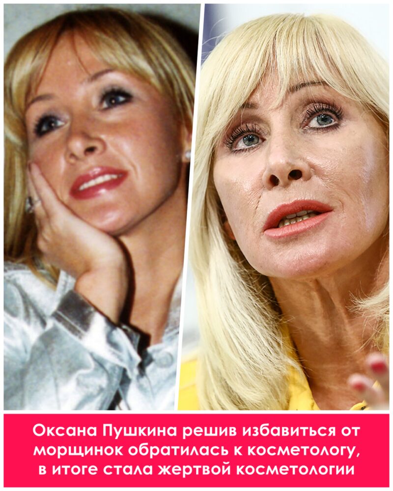 Цена совершенства: как пластика изменила жизни российских звезд