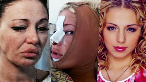 Красота за большие деньги: 6 актрис, которые дорого расплатились за попытку омолодиться