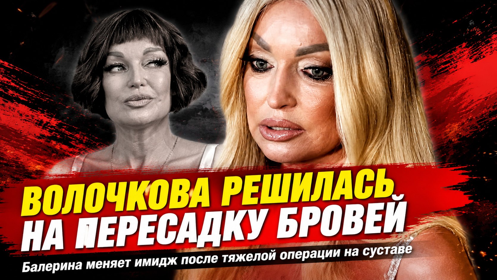 Пересадка бровей после сложной операции: почему Анастасию Волочкову снова обсуждают в Сети