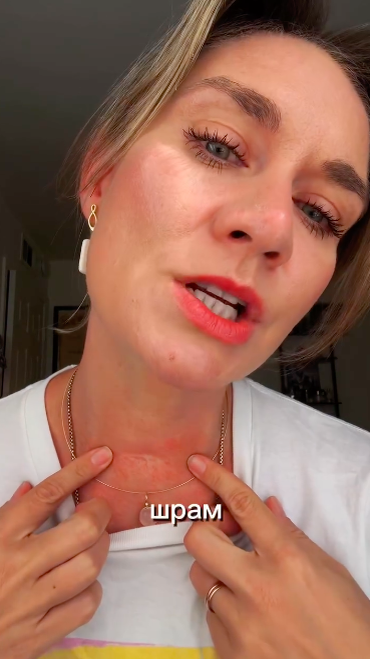 Мария Машкова показала шрам на шее