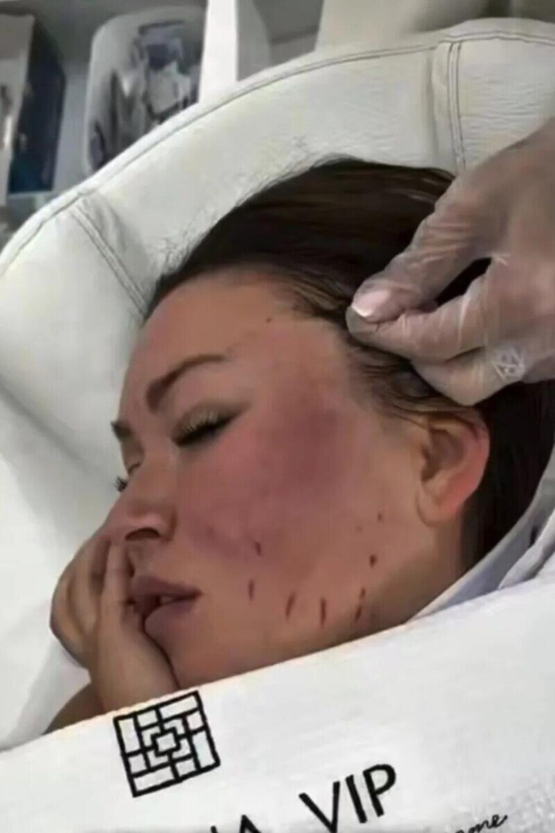 Ирина Дубцова во время нитевого лифтинга