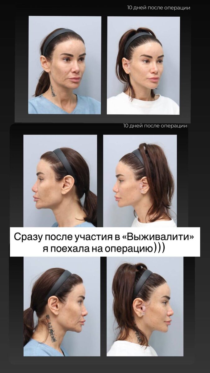 Айза сочла себя слишком слабой для «Выживалити» — и улетела на лифтинг в Сеул